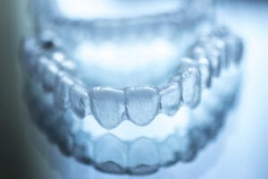 Come funzionano le mascherine per i denti